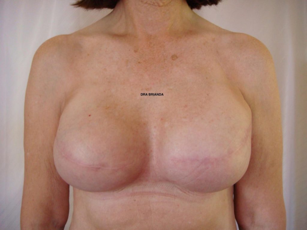 Breast Reconstruction Cases