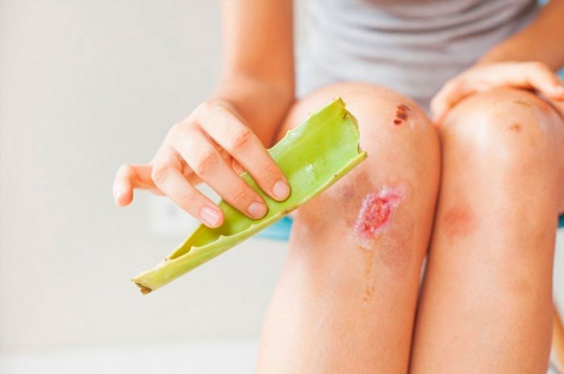 The effects of Aloe Vera on wound healing - Doctora Brianda