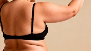 Brazos flácidos: cuándo funciona la radiofrecuencia y cuándo necesitas una braquioplastia
