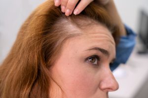 Caída del cabello en mujeres: causas, diagnóstico y tratamientos más efectivos